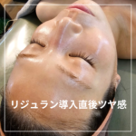 リジュラン導入直後_水光ピールスキン